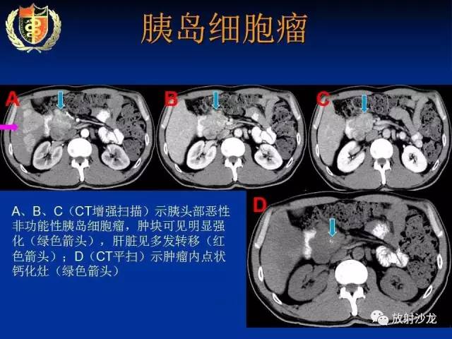 【PPT】胰腺疾病的影像诊断
