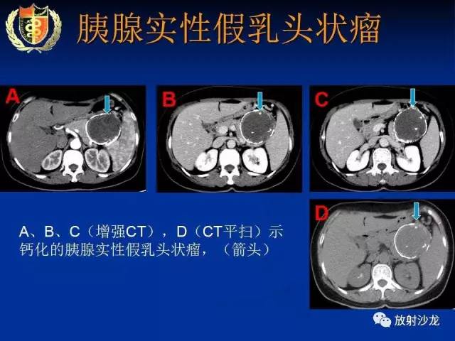 【PPT】胰腺疾病的影像诊断