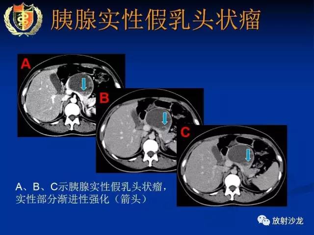 【PPT】胰腺疾病的影像诊断
