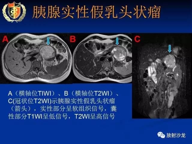 【PPT】胰腺疾病的影像诊断