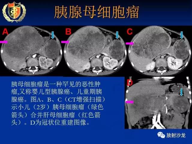 【PPT】胰腺疾病的影像诊断