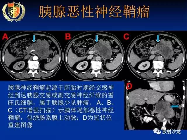 【PPT】胰腺疾病的影像诊断