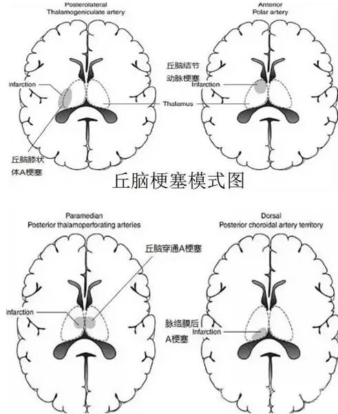 【病例】Percheron动脉梗死1例 【病例】Percheron动脉梗死1例