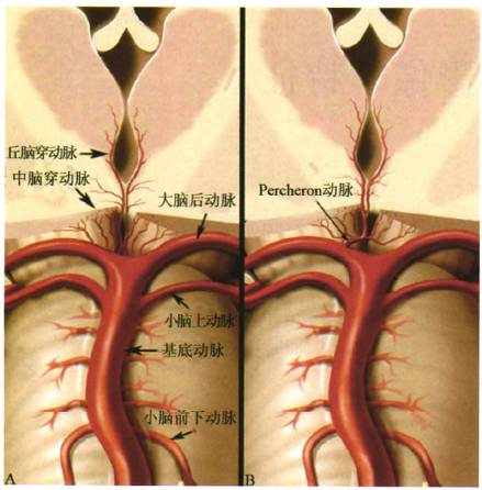 【病例】Percheron动脉梗死1例 【病例】Percheron动脉梗死1例