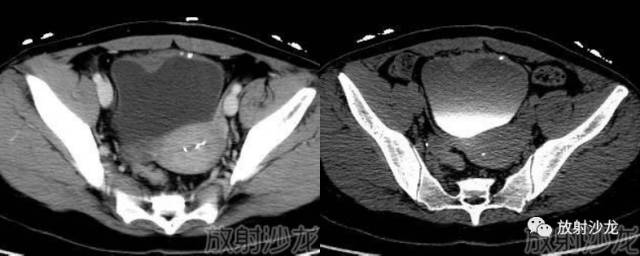 【病例】膀胱海绵状血管瘤伴血栓形成1例