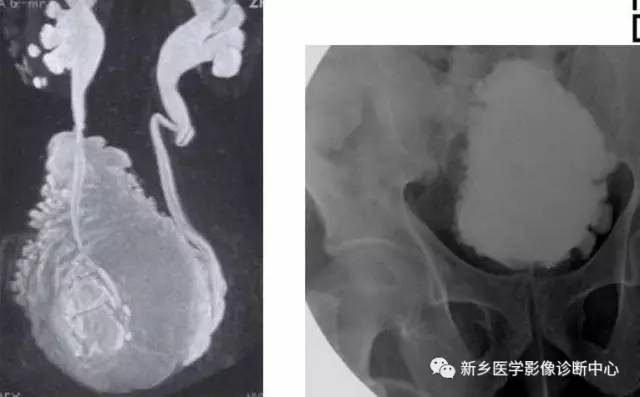 膀胱异常，应想到的18种膀胱病变