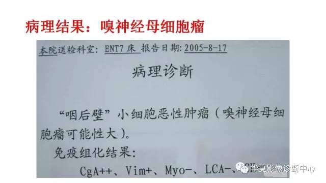 【病例】咽后壁嗅神经母细胞瘤1例