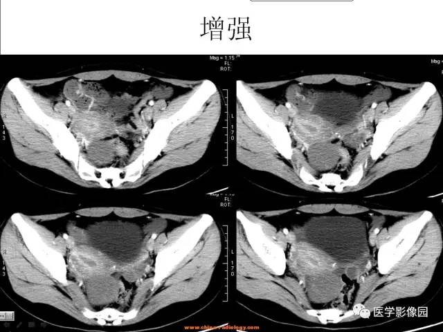 【病例】卵巢纤维瘤1例CT影像表现 【病例】卵巢纤维瘤1例CT影像表现