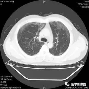 肺泡蛋白质沉积症
