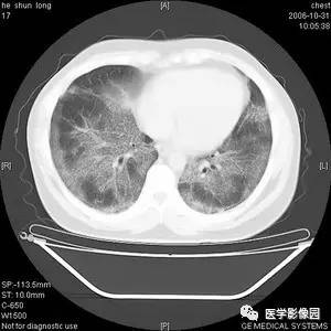 肺泡蛋白质沉积症 肺泡蛋白质沉积症
