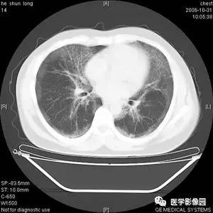 肺泡蛋白质沉积症 肺泡蛋白质沉积症
