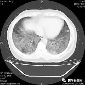 肺泡蛋白质沉积症 肺泡蛋白质沉积症