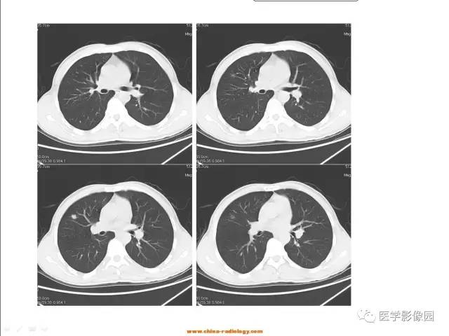【病例】肺内孤立性结节——肺癌1例CT