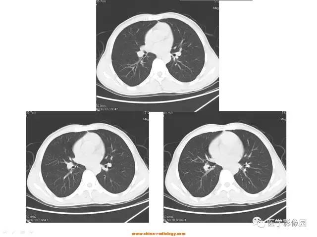 【病例】肺内孤立性结节——肺癌1例CT