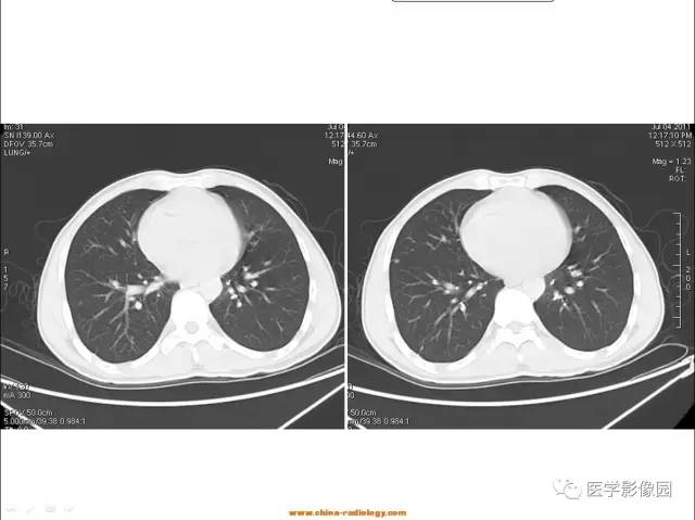 【病例】肺内孤立性结节——肺癌1例CT