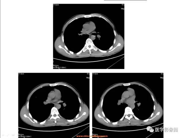 【病例】肺内孤立性结节——肺癌1例CT