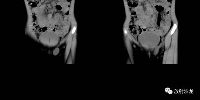 【病例】左侧Nuck囊肿(子宫圆韧带囊肿)1例 【病例】左侧Nuck囊肿(子宫圆韧带囊肿)1例