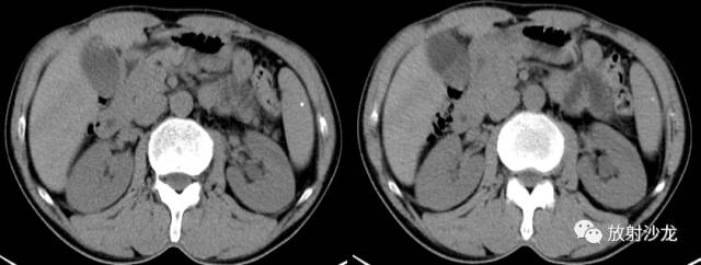 【病例】胆囊腺肌症1例CT病例解读 【病例】胆囊腺肌症1例CT病例解读