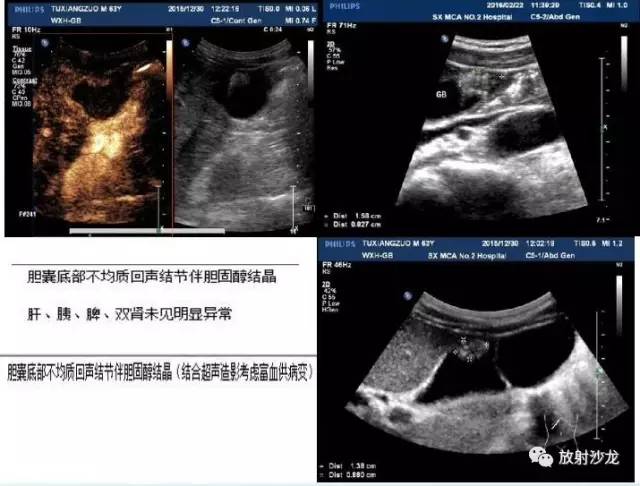【病例】胆囊腺肌症1例CT病例解读 【病例】胆囊腺肌症1例CT病例解读