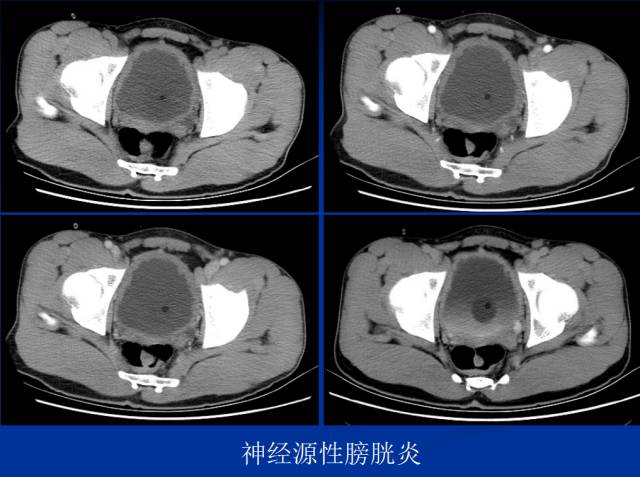 【PPT】泌尿系疾病的影像诊断