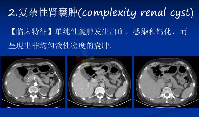【PPT】泌尿系疾病的影像诊断
