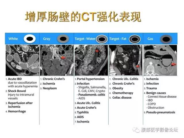 【PPT】肠道壁增厚CT表现