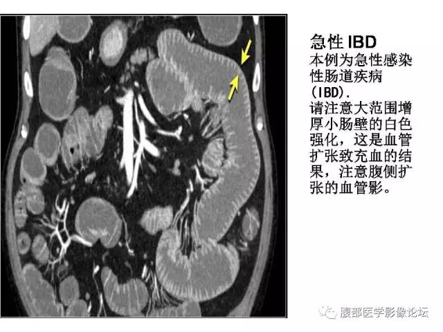 【PPT】肠道壁增厚CT表现