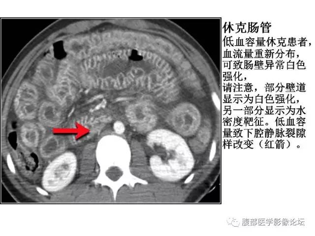 【PPT】肠道壁增厚CT表现