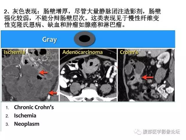 【PPT】肠道壁增厚CT表现