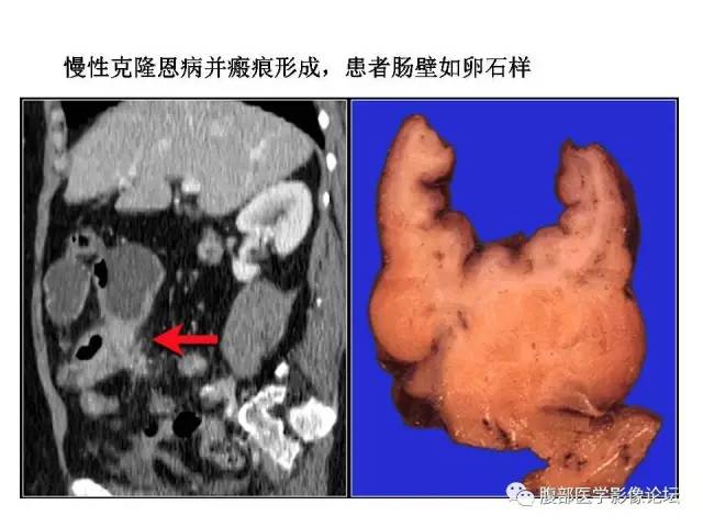 【PPT】肠道壁增厚CT表现