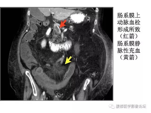【PPT】肠道壁增厚CT表现