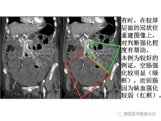 【PPT】肠道壁增厚CT表现