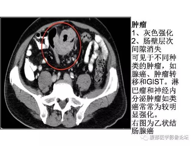 【PPT】肠道壁增厚CT表现