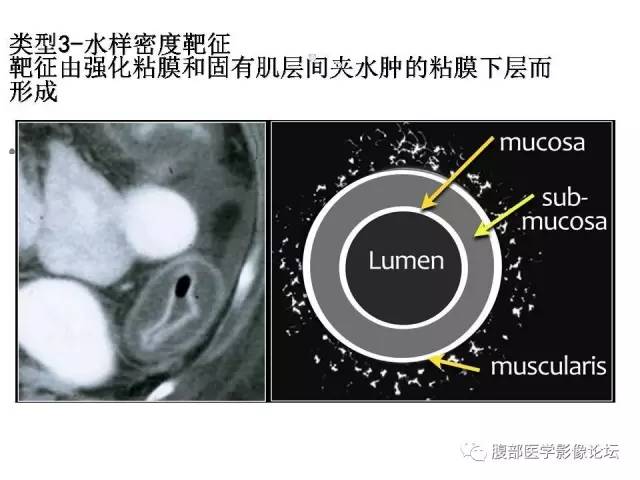 【PPT】肠道壁增厚CT表现