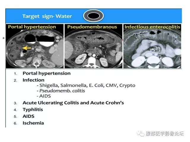 【PPT】肠道壁增厚CT表现
