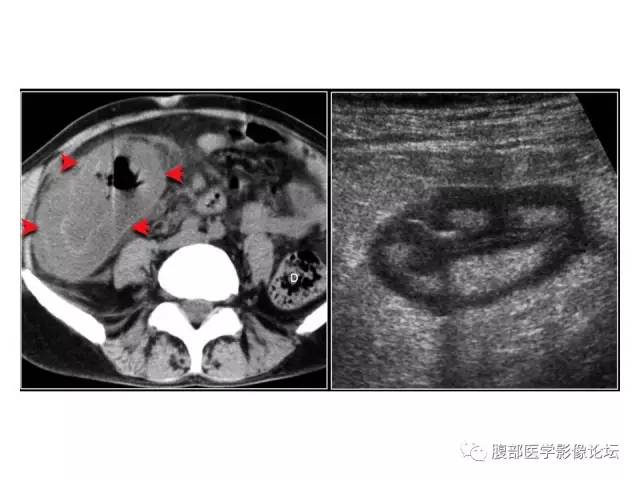 【PPT】肠道壁增厚CT表现