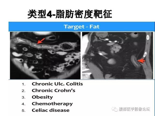 【PPT】肠道壁增厚CT表现