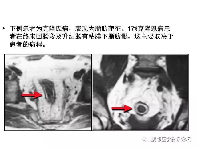【PPT】肠道壁增厚CT表现