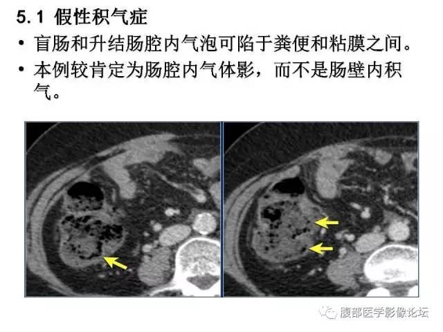 【PPT】肠道壁增厚CT表现