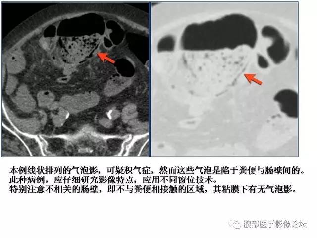 【PPT】肠道壁增厚CT表现