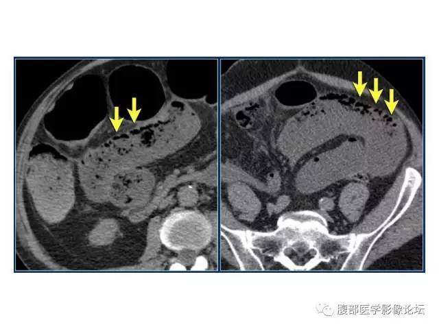 【PPT】肠道壁增厚CT表现