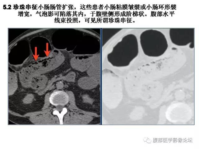 【PPT】肠道壁增厚CT表现