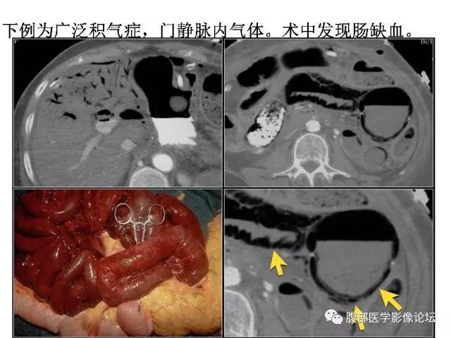 【PPT】肠道壁增厚CT表现