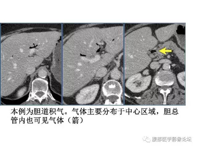 【PPT】肠道壁增厚CT表现