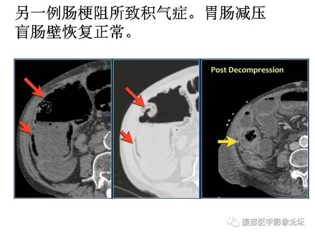 【PPT】肠道壁增厚CT表现