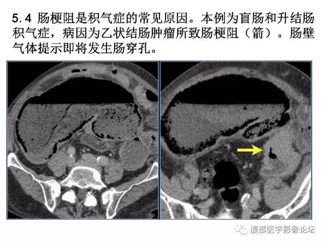 【PPT】肠道壁增厚CT表现
