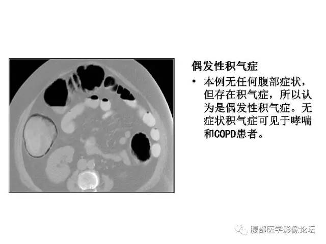 【PPT】肠道壁增厚CT表现
