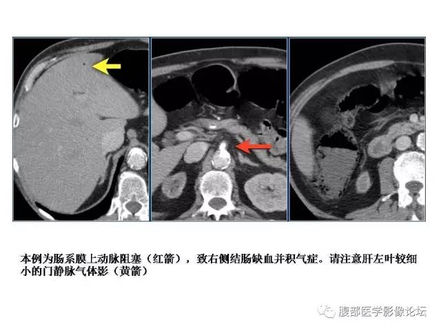 【PPT】肠道壁增厚CT表现