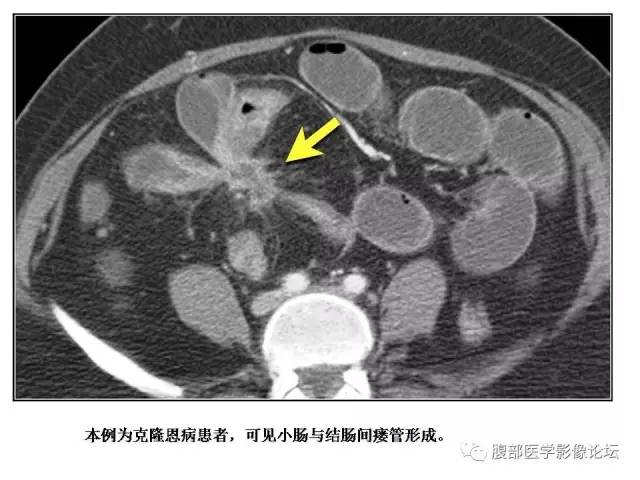 【PPT】肠道壁增厚CT表现