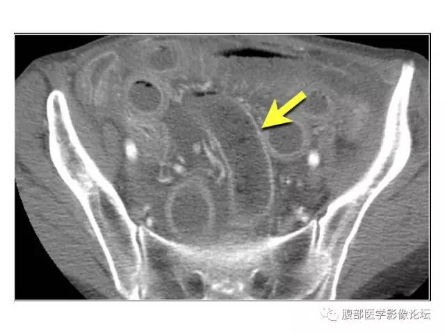 【PPT】肠道壁增厚CT表现